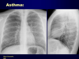 Asthma:

Marc Gosselin,
MD

 