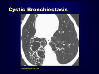 Cystic Bronchiectasis

www.emedicine.com

 