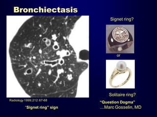 Bronchiectasis
Signet ring?

or

Solitaire ring?
Radiology 1999; 212: 67-68

“Signet ring” sign

“Question Dogma”

…Marc Gosselin, MD

 