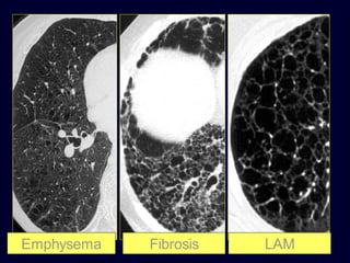 Emphysema

Fibrosis

LAM

 