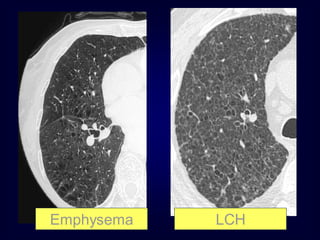 Emphysema

LCH

 