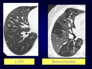 LCH

Bronchiolitis

 
