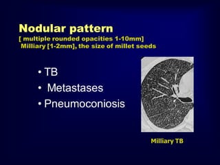 Nodular pattern

[ multiple rounded opacities 1-10mm]
Milliary [1-2mm], the size of millet seeds

• TB
• Metastases
• Pneumoconiosis
Milliary TB

 