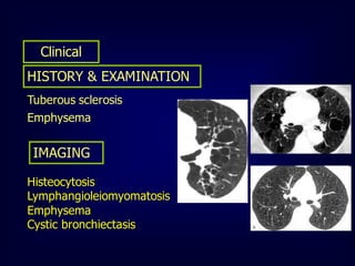 Clinical
HISTORY & EXAMINATION
Tuberous sclerosis
Emphysema

IMAGING
Histeocytosis
Lymphangioleiomyomatosis
Emphysema
Cystic bronchiectasis

 