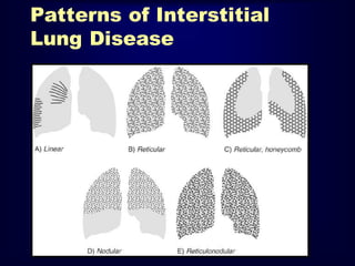 Patterns of Interstitial
Lung Disease

 