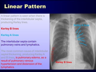 Linear Pattern
A linear pattern is seen when there is
thickening of the interlobular septa,
producing Kerley lines.
Kerley A lines

Kerley B lines
Kerley A lines

The interlobular septa contain
pulmonary veins and lymphatics.
The most common cause of interlobular
septal thickening, producing Kerley A
and B lines, is pulmonary edema, as a
result of pulmonary venous
hypertension and distension of the
lymphatics.

Kerley B lines

 