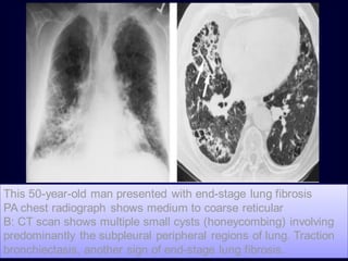 This 50-year-old man presented with end-stage lung fibrosis
PA chest radiograph shows medium to coarse reticular
B: CT scan shows multiple small cysts (honeycombing) involving
predominantly the subpleural peripheral regions of lung. Traction
bronchiectasis, another sign of end-stage lung fibrosis.

 