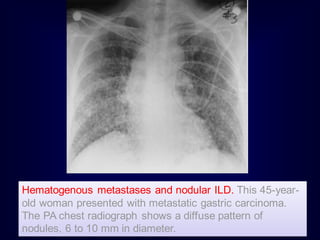 Hematogenous metastases and nodular ILD. This 45-yearold woman presented with metastatic gastric carcinoma.
The PA chest radiograph shows a diffuse pattern of
nodules, 6 to 10 mm in diameter.

 
