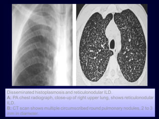 Disseminated histoplasmosis and reticulonodular ILD.
A: PA chest radiograph, close-up of right upper lung, shows reticulonodular
ILD.
B: CT scan shows multiple circumscribed round pulmonary nodules, 2 to 3
mm in diameter.

 