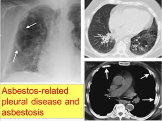 Asbestos-related
pleural disease and
asbestosis

 