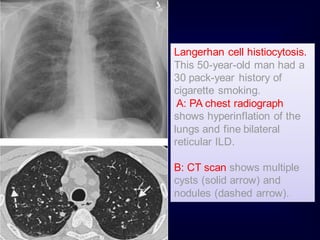 Langerhan cell histiocytosis.
This 50-year-old man had a
30 pack-year history of
cigarette smoking.
A: PA chest radiograph
shows hyperinflation of the
lungs and fine bilateral
reticular ILD.
B: CT scan shows multiple
cysts (solid arrow) and
nodules (dashed arrow).

 