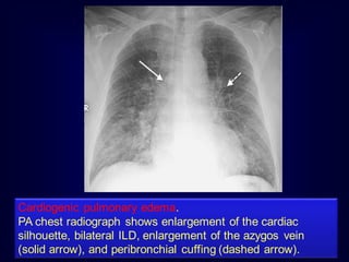 Cardiogenic pulmonary edema.
PA chest radiograph shows enlargement of the cardiac
silhouette, bilateral ILD, enlargement of the azygos vein
(solid arrow), and peribronchial cuffing (dashed arrow).

 