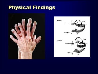 Physical Findings
•
•
•
•
•
•

Resting Tachypnea
Shallow breathing
Dry crackles
Digital clubbing
Pulmonary HTN
Non-pulmonary
findings

 