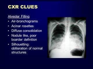 CXR CLUES
Alveolar Filling
• Air-bronchograms
• Acinar rosettes
• Diffuse consolidation
• Nodule like, poor
boarder definition
• Silhouetting:
obliteration of normal
structures

 