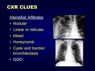 CXR CLUES
Interstitial Infiltrates
• Nodular
• Linear or reticular
• Mixed

• Honeycomb
• Cysts and traction
bronchiectasis
• GGO

 