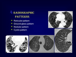 4 Radiographic
patterns






Reticular pattern
Ground glass pattern
Nodular pattern
Cystic pattern

 
