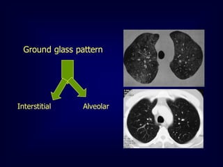 Ground glass pattern

Interstitial

Alveolar

 