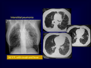 Interstitial peumonia

50 Y F, with cough and fever

 
