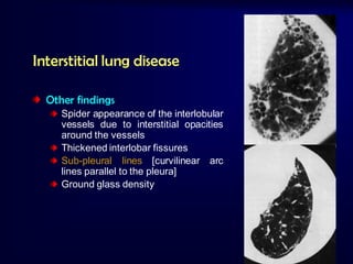 Interstitial lung disease
Other findings
Spider appearance of the interlobular
vessels due to interstitial opacities
around the vessels
Thickened interlobar fissures
Sub-pleural lines [curvilinear arc
lines parallel to the pleura]
Ground glass density

 