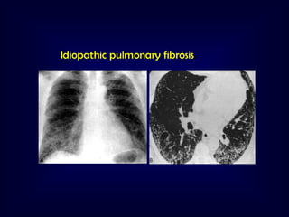 Idiopathic pulmonary fibrosis

 