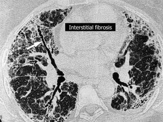 Interstitial fibrosis

 