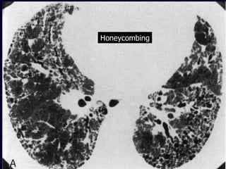 Honeycombing

 