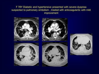 F 78Y Diabetic and hypertensive presented with severe dyspnea
suspected to pulmonary embolism , treated with anticoagulants with mild
improvement

 