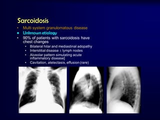 Sarcoidosis
•

Multi system granulomatous disease

• Unknown etiology
•

90% of patients with sarcoidosis have
chest changes
•
•
•
•

Bilateral hilar and mediastinal adopathy
Interstitial disease  lymph nodes
Alveolar pattern simulating acute
inflammatory disease]
Cavitation, atelectasis, effusion (rare)

 
