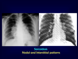 Sarcoidosis
Nodal and Interstitial patterns

 