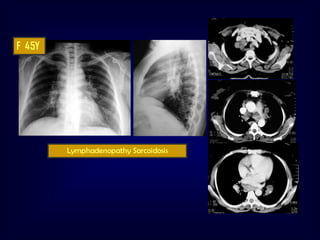 F 45Y

Lymphadenopathy Sarcoidosis

 