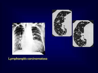 Lymphangitis carcinomatosa

 