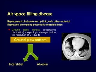 Air space filling disease
Replacement of alveolar air by fluid, cells, other material
Represents an ongoing potentially treatable lesion
Ground glass density [geographic
distribution] morphologic changes below
the resolution of CT due to

Ground glass pattern

Interstitial

Alveolar

 