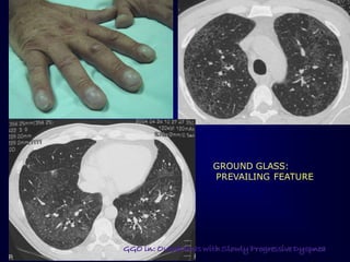 GROUND GLASS:
PREVAILING FEATURE

ERS 2008

GGO in: Outpatients with Slowly Progressive Dyspnea

 