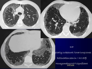 DIP
Typically: subpleural /lower lung zones
Reticulation seen in ~40-50%
Honeycombing NOT significant
ERS 2008

 