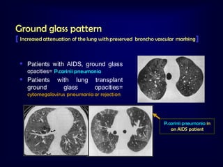 Ground glass pattern

[ Increased attenuation of the lung with preserved

broncho vascular marking ]

 Patients with AIDS, ground glass
opacities= P.carinii pneumonia

 Patients
ground

with lung
glass

transplant
opacities=

cytomegalovirus pneumonia or rejection

P.carinii pneumonia in
an AIDS patient

 