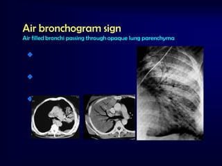 Air bronchogram sign
Air filled bronchi passing through opaque lung parenchyma

Pulmonary
lesion
Alveolar
pathology

Consolidation

 