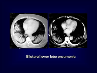 Bilateral lower lobe pneumonia

 