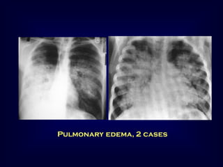 Pulmonary edema, 2 cases

 