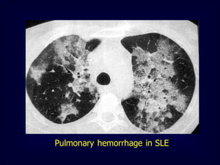 Pulmonary hemorrhage in SLE

 