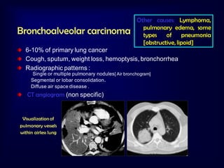 Bronchoalveolar carcinoma

Other causes: Lymphoma,
pulmonary edema, some
types
of
pneumonia
[obstructive, lipoid]

6-10% of primary lung cancer
Cough, sputum, weight loss, hemoptysis, bronchorrhea
Radiographic patterns :
Single or multiple pulmonary nodules [ Air bronchogram]
Segmental or lobar consolidation.
Diffuse air space disease .

CT angiogram (non specific)

Visualization of
pulmonary vessels
within airless lung

 
