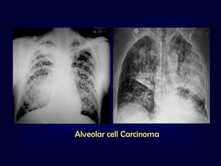 Alveolar cell Carcinoma

 