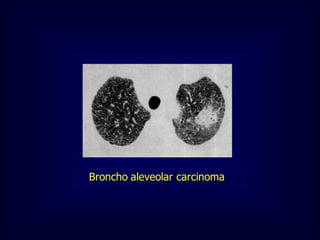 Broncho aleveolar carcinoma

 