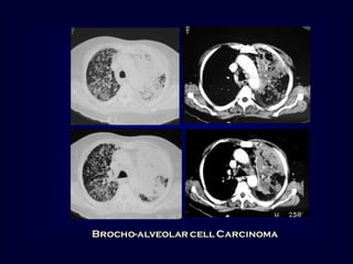 Brocho-alveolar cell Carcinoma

 