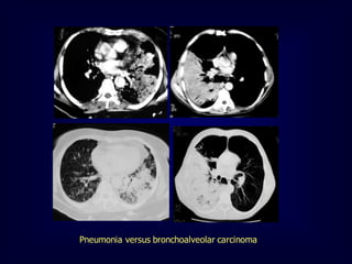 Pneumonia versus bronchoalveolar carcinoma

 