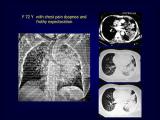 F 72 Y with chest pain dyspnea and
frothy expectoration

 