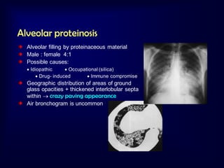 Alveolar proteinosis
Alveolar filling by proteinaceous material
Male : female 4:1
Possible causes:
 Idiopathic
 Occupational (silica)
 Drug- induced
 Immune compromise

Geographic distribution of areas of ground
glass opacities + thickened interlobular septa
within  crazy paving appearance
Air bronchogram is uncommon

 