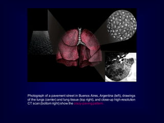 Photograph of a pavement street in Buenos Aires, Argentina (left), drawings
of the lungs (center) and lung tissue (top right), and close-up high-resolution
CT scan (bottom right) show the crazy-paving pattern.

 