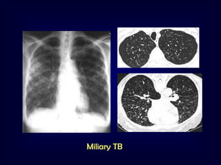 Miliary TB

 