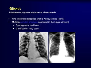 Silicosis
Inhalation of high concentrations of silicon dioxide
•
•

Fine interstitial opacities with B Kerley’s lines (early)
Multiple nodular shadows scattered in the lungs (classic)
• Sparing apex and base
• Calcification may occur

 