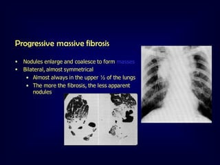 Progressive massive fibrosis



Nodules enlarge and coalesce to form masses
Bilateral, almost symmetrical
• Almost always in the upper ½ of the lungs
• The more the fibrosis, the less apparent
nodules

 